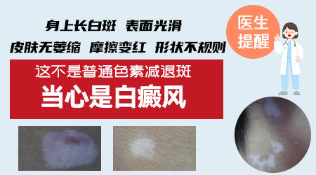 预防护理-什么食物对治疗白癜风有好处呢？